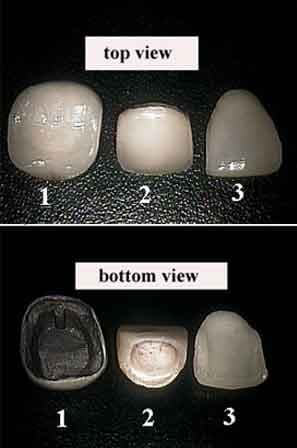 Comparison of dental crowns and porcelain veneers showing the difference in tooth coverage
