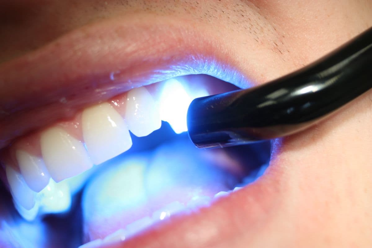 Dental curing light used to bond porcelain veneers to prepared teeth