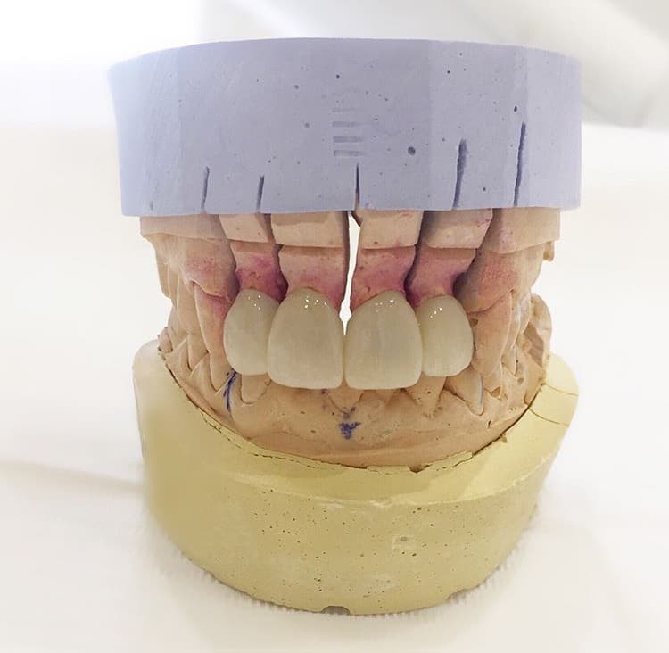 E-Max lithium disilicate veneers on a dental model showing translucency and natural appearance